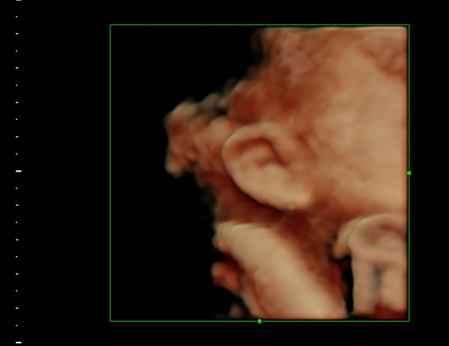 3D ultrasound image at 33 weeks